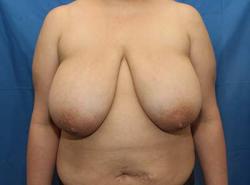 Before Results for Breast Reduction