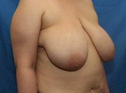 Before Results for Breast Reduction