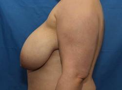 Before Results for Breast Reduction