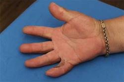 After Results for Wound Care, Hand Surgery