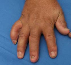 After Results for Wound Care, Hand Surgery