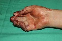 Before Results for Wound Care, Hand Surgery