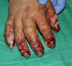 Before Results for Wound Care, Hand Surgery