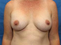 After Results for Breast Augmentation
