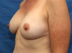 After Results for Breast Augmentation