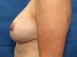 After Results for Breast Augmentation