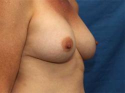 After Results for Breast Augmentation