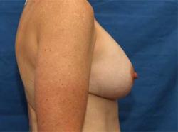 After Results for Breast Augmentation
