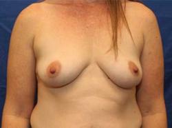 Before Results for Breast Augmentation