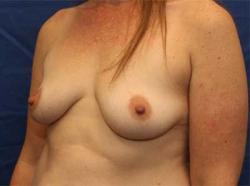 Before Results for Breast Augmentation