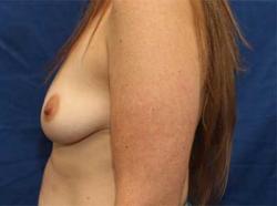 Before Results for Breast Augmentation