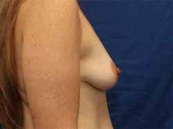Before Results for Breast Augmentation