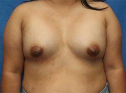 After Results for Breast Augmentation