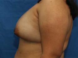 After Results for Breast Augmentation
