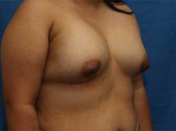 After Results for Breast Augmentation