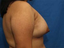 After Results for Breast Augmentation