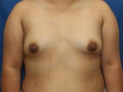 Before Results for Breast Augmentation