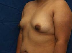 Before Results for Breast Augmentation