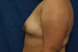 Before Results for Breast Augmentation