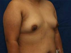 Before Results for Breast Augmentation