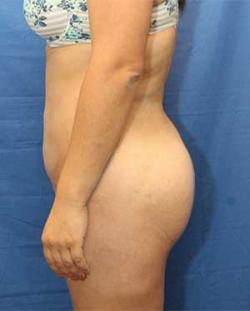After Results for Gluteal Augmentation