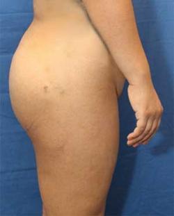 After Results for Gluteal Augmentation