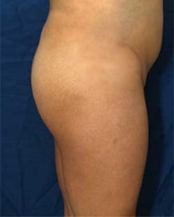 Before Results for Gluteal Augmentation