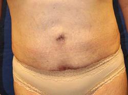 After Results for Tummy Tuck