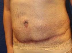 After Results for Tummy Tuck