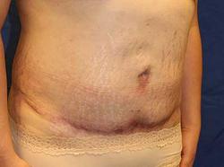 After Results for Tummy Tuck