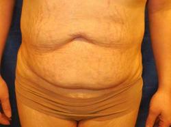 Before Results for Tummy Tuck