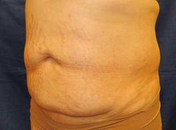 Before Results for Tummy Tuck