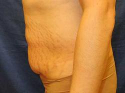 Before Results for Tummy Tuck