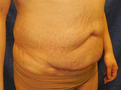 Before Results for Tummy Tuck