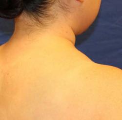 After Results for Liposuction