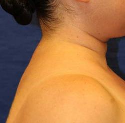 After Results for Liposuction