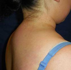 Before Results for Liposuction