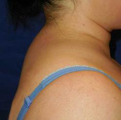 Before Results for Liposuction