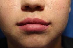 After Results for Lip Augmentation