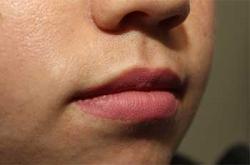 After Results for Lip Augmentation