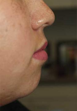 After Results for Lip Augmentation