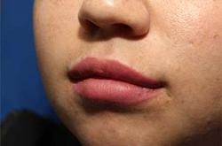 After Results for Lip Augmentation