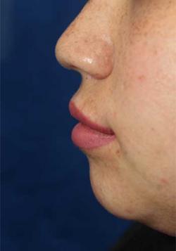 After Results for Lip Augmentation