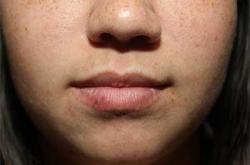 Before Results for Lip Augmentation