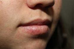 Before Results for Lip Augmentation