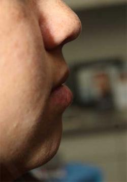 Before Results for Lip Augmentation