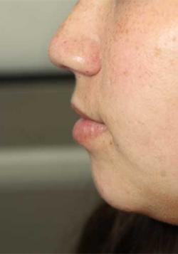 Before Results for Lip Augmentation