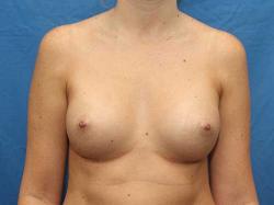 After Results for Breast Augmentation