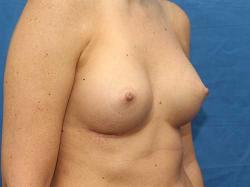 After Results for Breast Augmentation