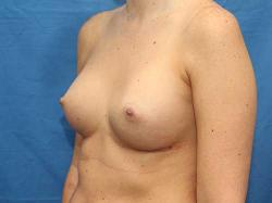 After Results for Breast Augmentation